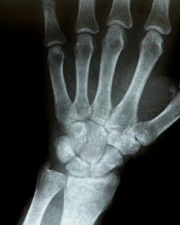 Avoid bone fractures in later life by preventing osteoporosis