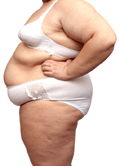 Gastric bypass - a solution for obesity